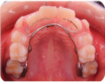 リンガルアーチ