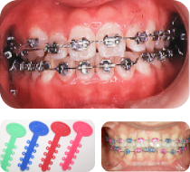 メタルブラケット